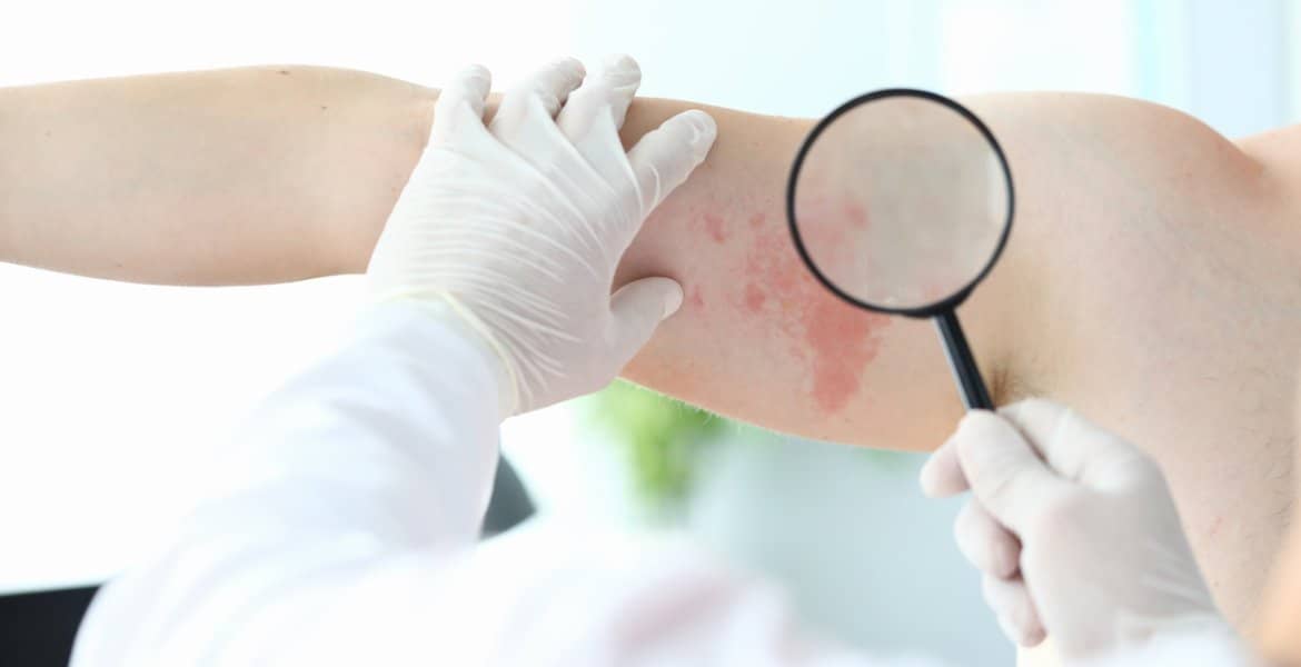 skin disorders