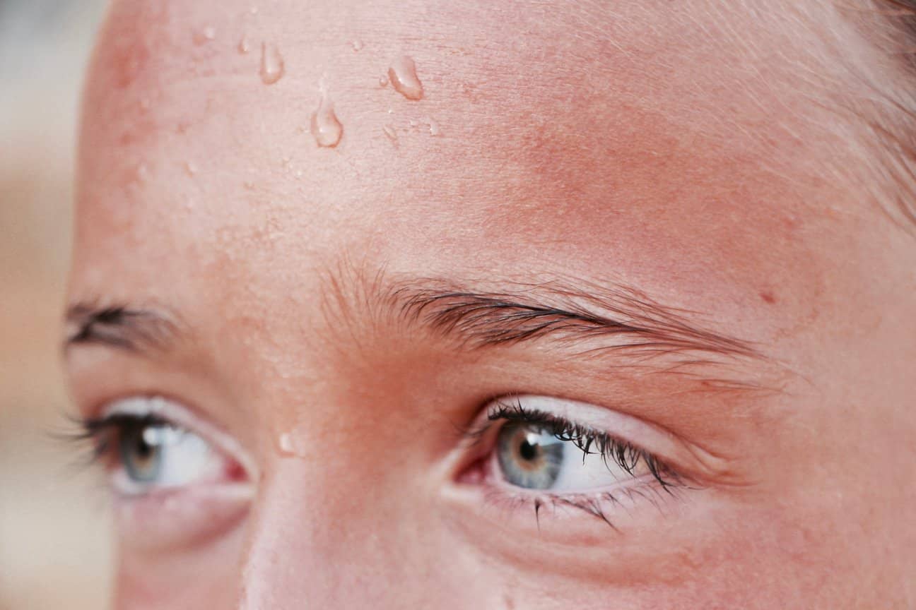 allergy to sweat