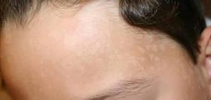 white spots on face