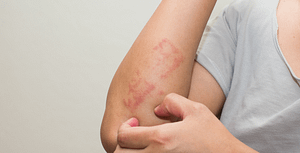 eczema