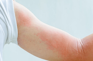 hives