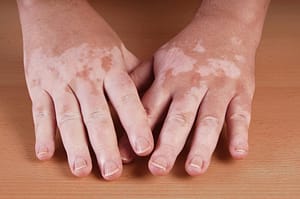 white spots on hands