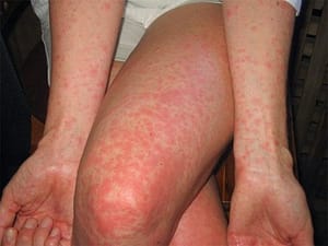 sun allergies