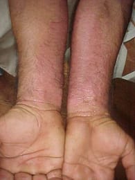 Wood allergies