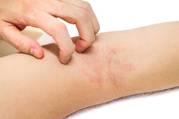 Allergic-contact-dermatitis symptoms