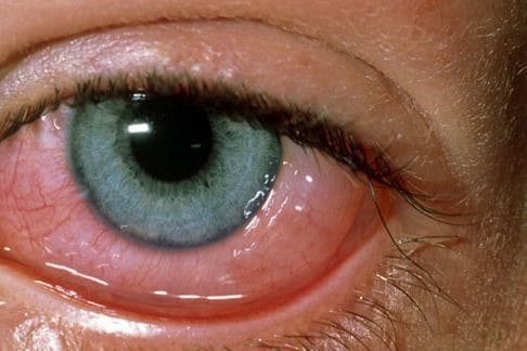 Perennial allergies