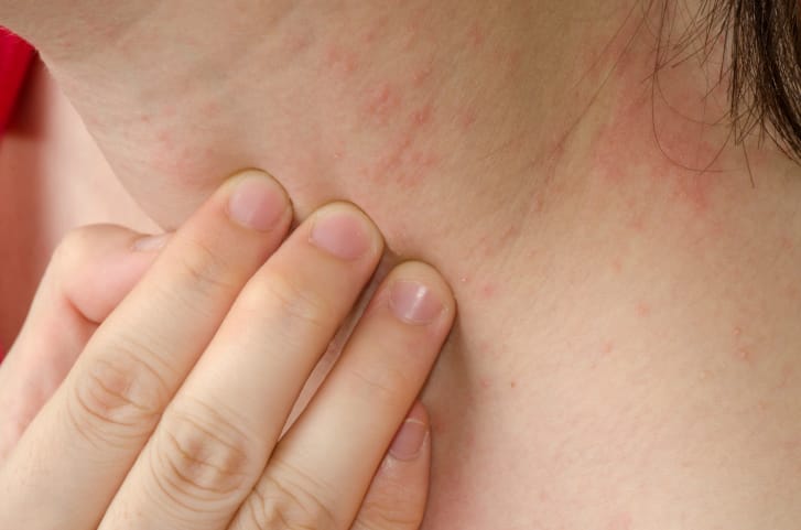 Summer Allergies skin