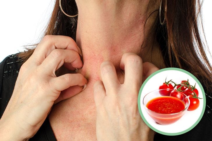 Tomato Allergy
