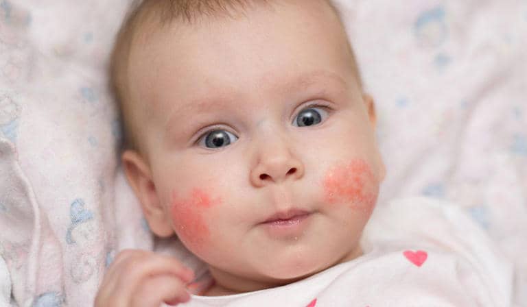 Causes of Allergies In Children 