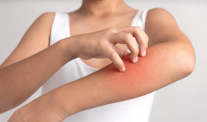 Hives (Urticaria): Causes, Symptoms & Treatment