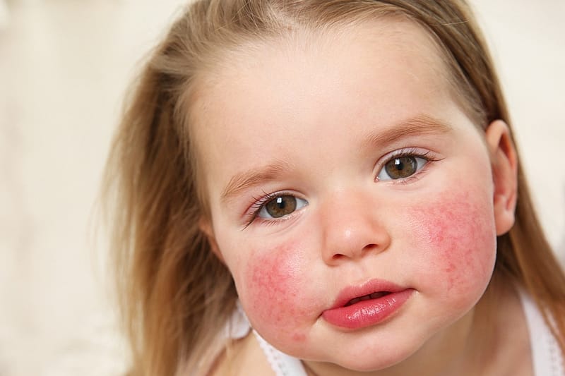 The causes of the emergence of Allergy in children