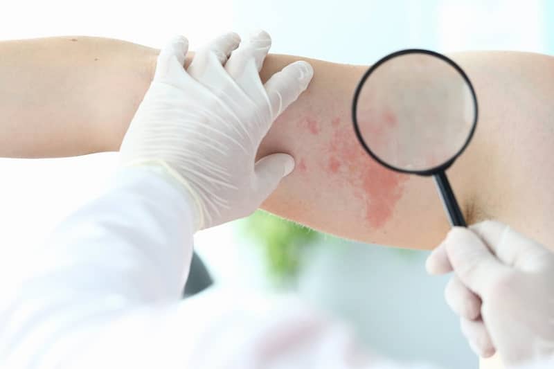 It is difficult to diagnose except by an expert.. 5 skin disorders that you may mistakenly think are urticaria